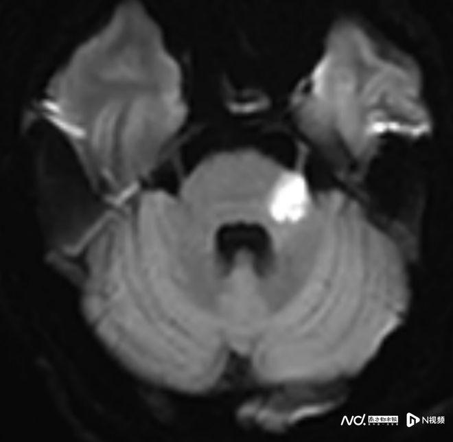 卒中發病呈現年輕化趨勢這個放松動作可能“按”出腦卒中(圖5)