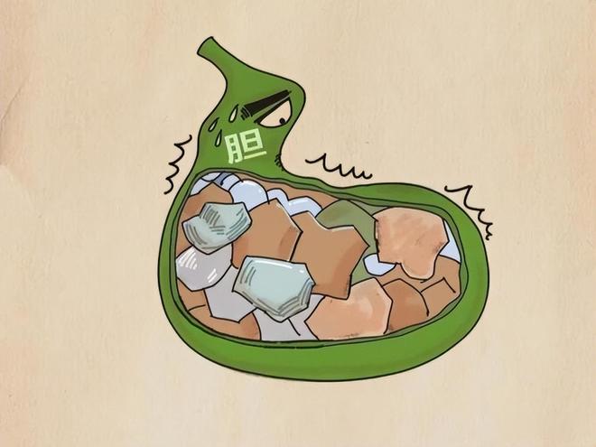 反胃？消化不良？不要硬扛！小心膽結石及時就醫別拖延(圖4)