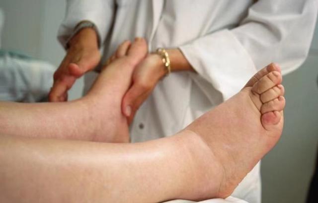 腿部是心梗的放大鏡?忠告:腿部出現這幾種表現盡快就醫!(圖4)